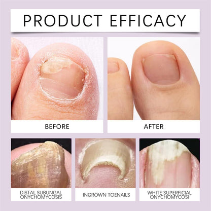 Bee Venom Nail Treatment Serum | 🔥BUY 1 GET 1 FREE🔥